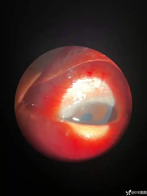 结膜炎的哪一类型