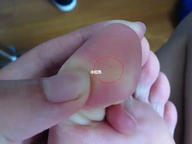 我花了3毛钱三天治好了我的鸡眼05