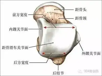 踝关节由胫骨下及内,外踝关节面共同形成的冂形结构,容纳距骨滑车