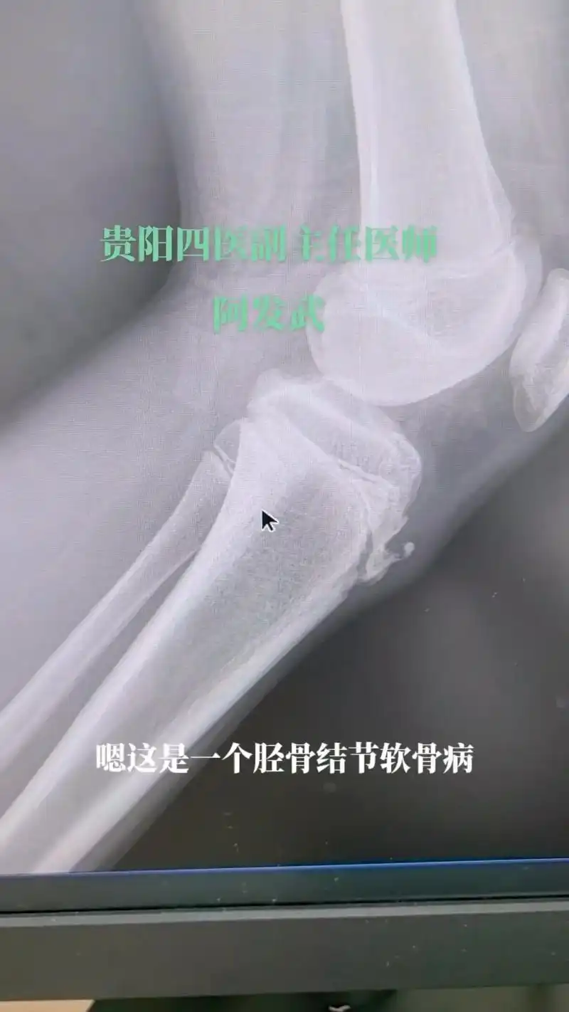 94今天给大家分享一个儿童常见病症——胫骨结节