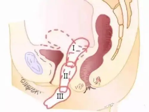 关于子宫脱垂,你一定得了解的那些事