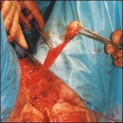 变性手术过程图示(男变女)