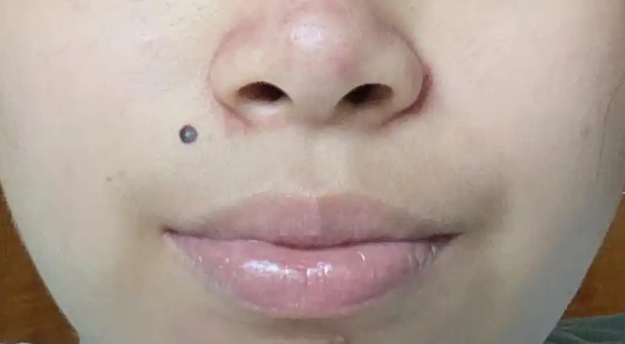 手术切痣媒婆痣