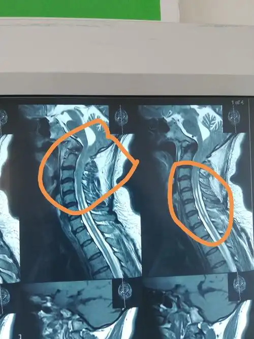 颈椎核磁示:c3水平下已形成脊髓空洞,提示:chiari i型.