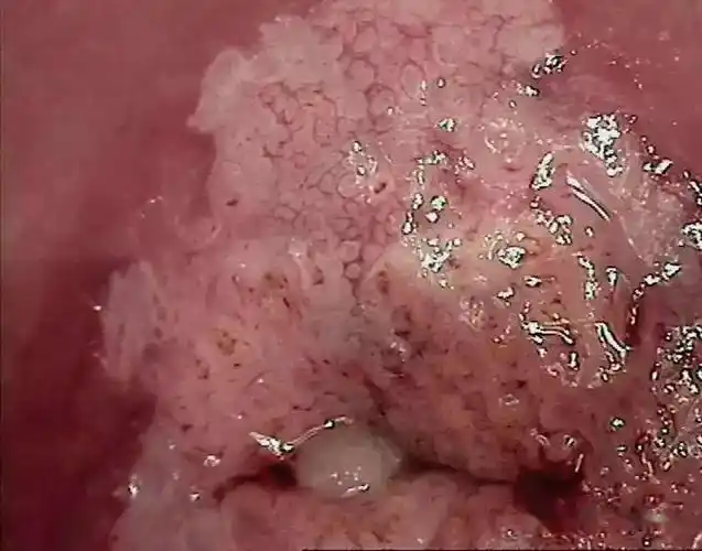 多图干货阴道镜下6种异常宫颈图像详解值得收藏