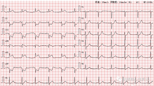 每日读图 || 第1725期 急性高侧壁心肌梗死 左前分支传导阻滞