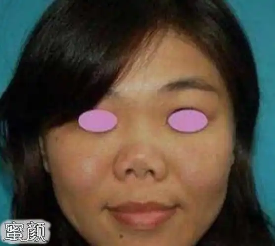 专家揭露最丑的几种鼻子图片,结果实在太扎心!