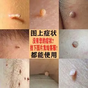 去脖子上的小肉粒