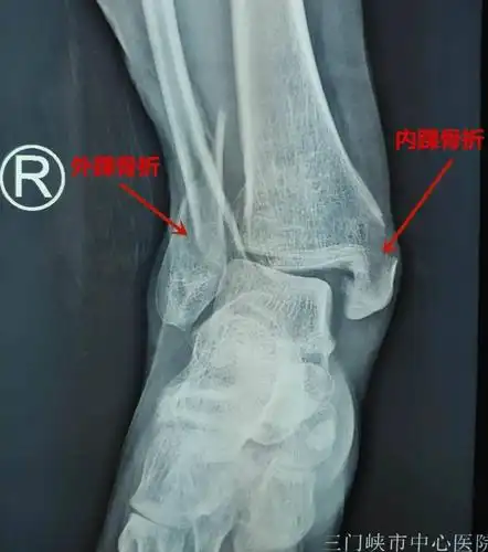 汤汤播报车祸导致内外后三踝骨折罗雪平团队接骨断续