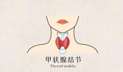发现甲状腺结节,怎么办?来看安佳琳医生怎么说