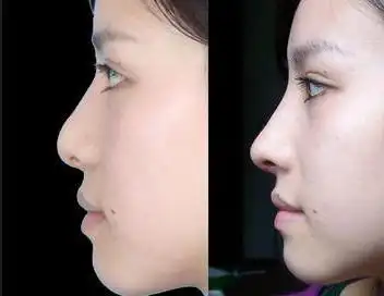 南京隆鼻硅胶的好吗