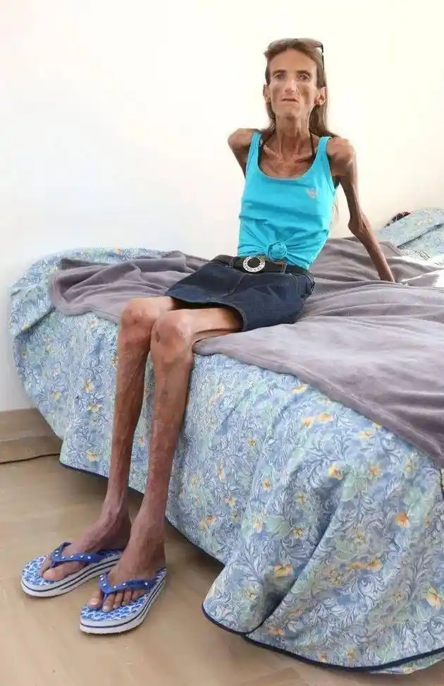 最轻的时候体重只有25公斤左右,一度被称为是"世界上最瘦的女人"