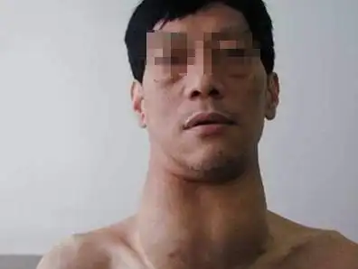 科普:甲亢的症状之一,颈部肿大!