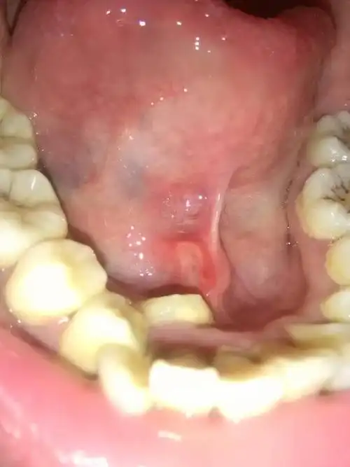 我的舌头下面长了一个奇怪的东西,又或许是口腔溃疡,好痛啊,说话都痛