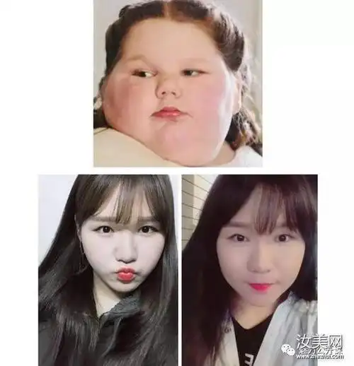 详情 脸胖会埋没立体的五官,不管你之前是男神or女神,脸胖让你离丑也