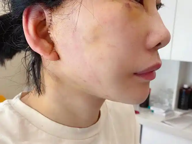 脸小一圈的体验,迷你拉皮术后七天对比