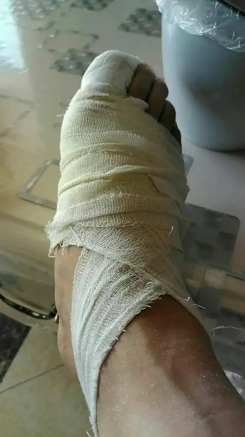 这只伤脚,是一只冠亚的脚.