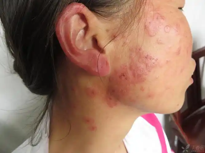 【共享】一例典型的多形性日光疹