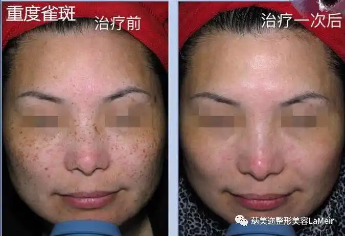 激光祛斑后反黑了快来看你是哪种情况