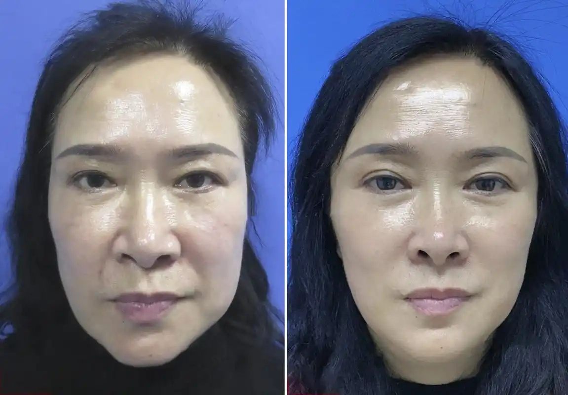 提眉,眼袋,安多泰拉皮是一个黄金套餐.