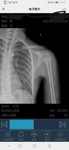 孩子摔伤,左肱骨近端骨折,是保守治疗还是动手术治疗好