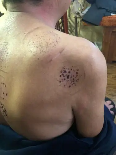 三角肌萎缩,肱三头肌萎缩,大小圆肌肉萎缩