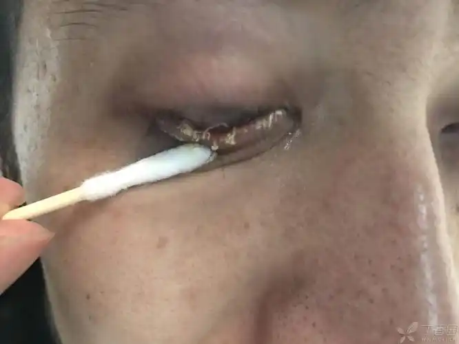 发图:睑板腺功能障碍!