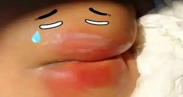 女婴红屁股反复发作甚至引发尿路感染原来都是这种纸尿裤惹的祸