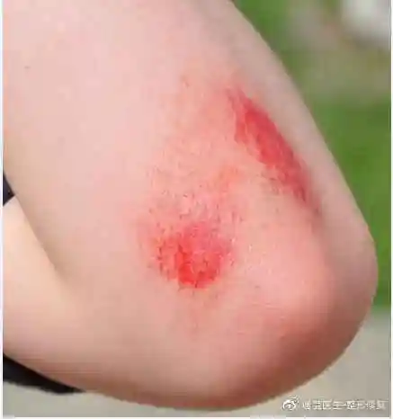 宝宝摔伤该不该缝针? (原创)_手机搜狐网