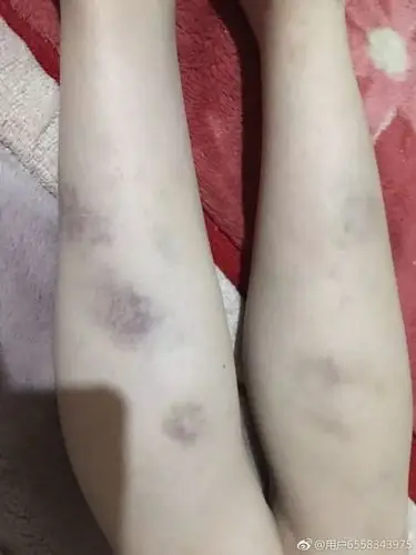网曝互助一学生被体罚全身多处淤青教育局回复已处理