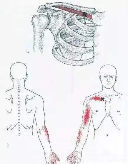 2,锁骨下肌会导致上肢传导疼痛,沿着肩前前臂桡侧向下,但是不在关节处