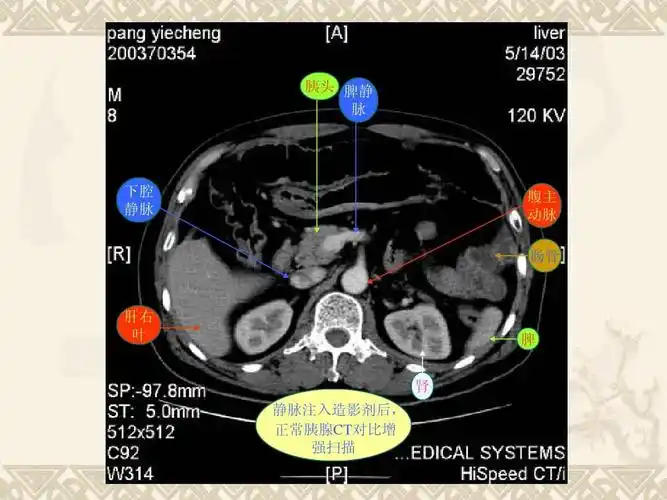胰腺基本疾病ct影像表现ppt