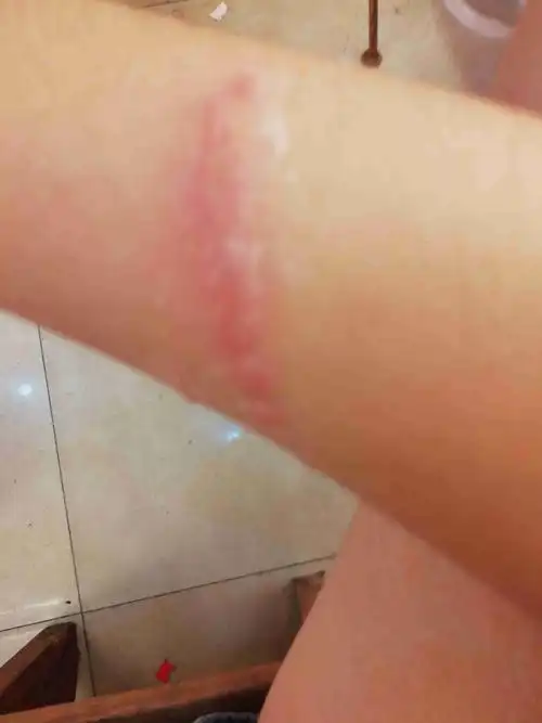 手上不小心被蜘蛛撒尿了,现在红肿有点浓咋办,要消毒吗?三天了