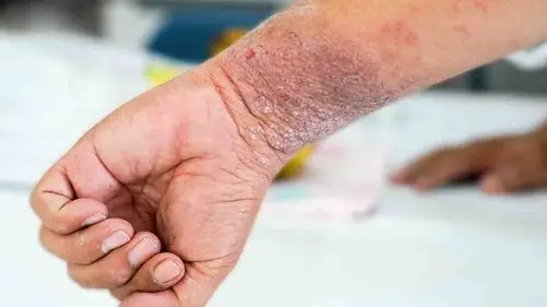 扁平苔藓的症状是什么样的-扁平苔癣概况-复禾健康