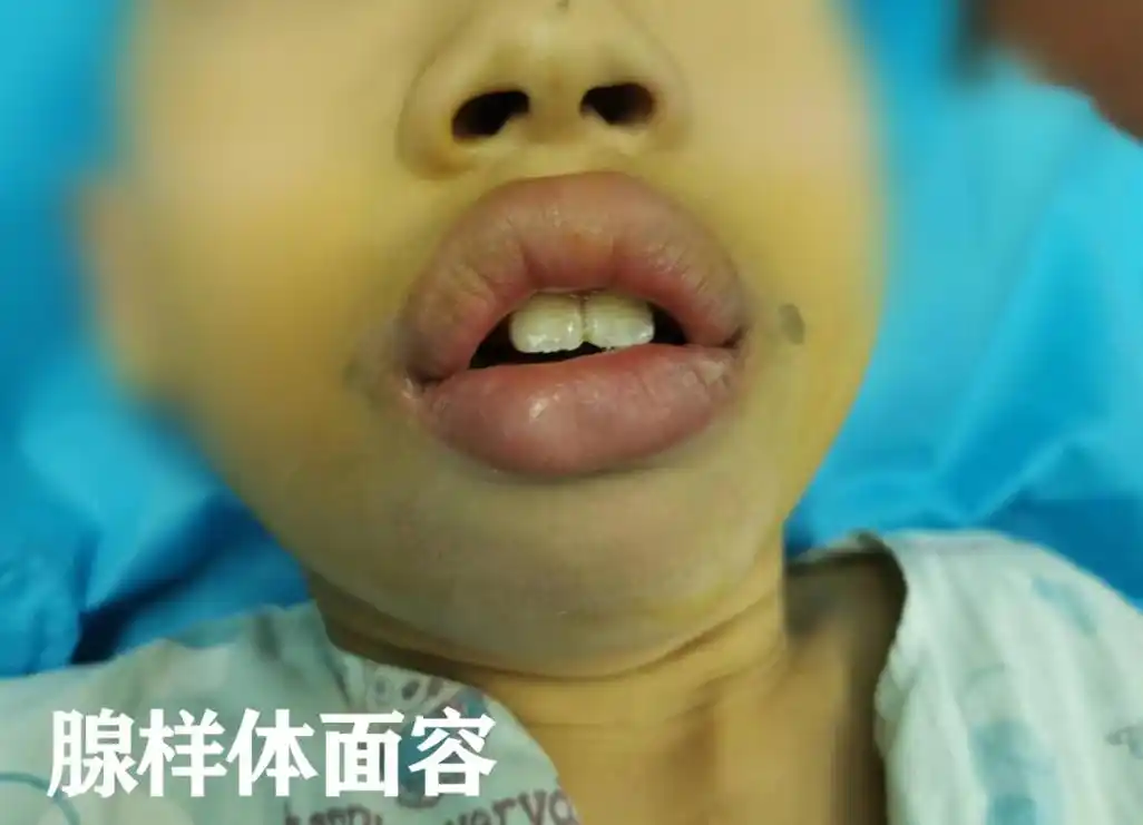 疾病不仅会导致儿童出现打鼾问题,甚至可能会导致孩子形成腺样体面容