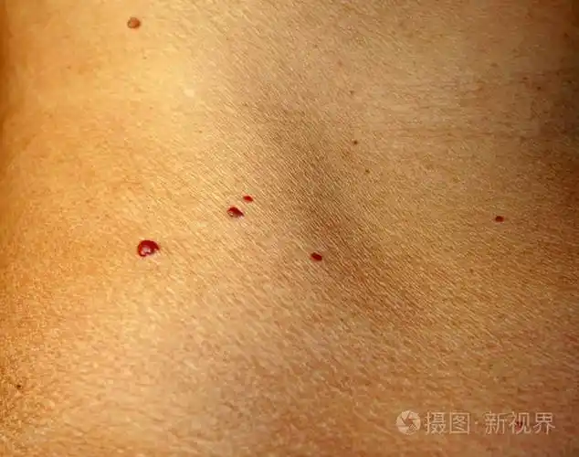 在皮肤上的血管瘤身体上的红痣许多的胎记