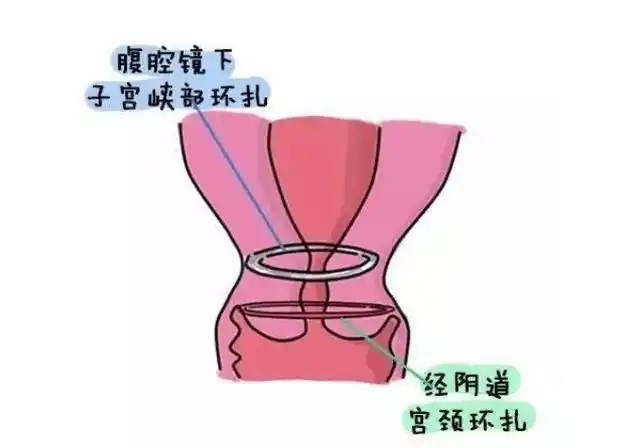 最常用的是经腹腔镜宫颈环扎术,手术的时机可以在孕前,也可是妊娠6-9