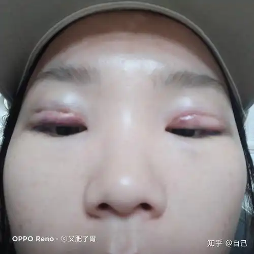 帮我看看我的埋线双眼皮失败了吗