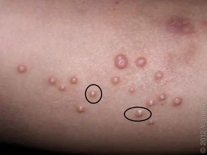 一传染性软疣是什么样子的?