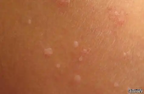 我老公胳膊上起了很多扁平的小疙瘩,是不是扁平疣啊,不疼不痒的,用点