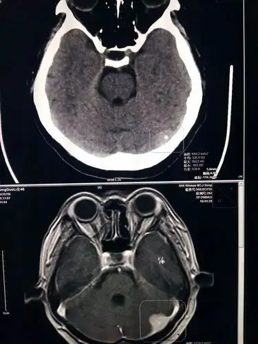 医学动态病例分享磁共振增强在脑占位病变诊断中的重要性