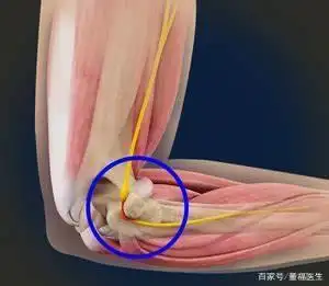 经常使用电脑,伏案写作的人群注意预防尺神经炎