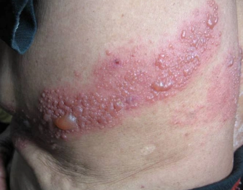 蜘蛛疮早期症状图片5