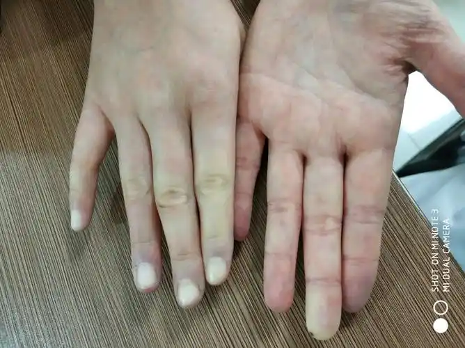 雷诺综合症属动脉痉挛性疾病,是肢端小动脉痉挛引起手或足部一系列