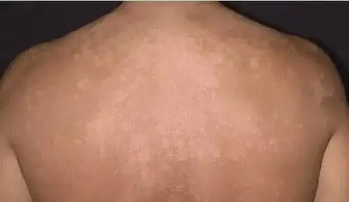 26岁小伙每天运动排出的汗水成了汗斑竟会传染