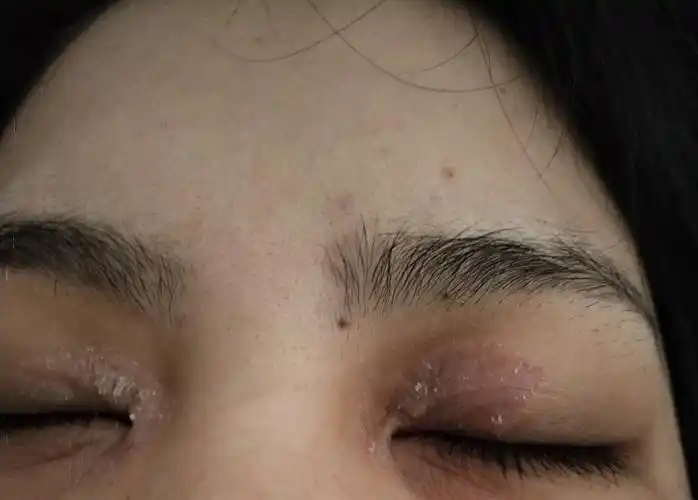 眼睛眼皮脱皮,干燥怎么回事啊?