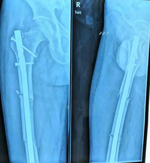 术后一月复查,骨痂生长良好