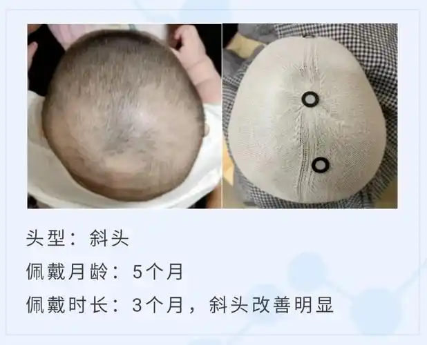 宝宝扁头偏头头型问题纠正前后对比14