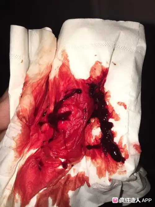 今天经期第二天血块特别多!上月打过促排针,吃过天喜丸!有点偏头痛