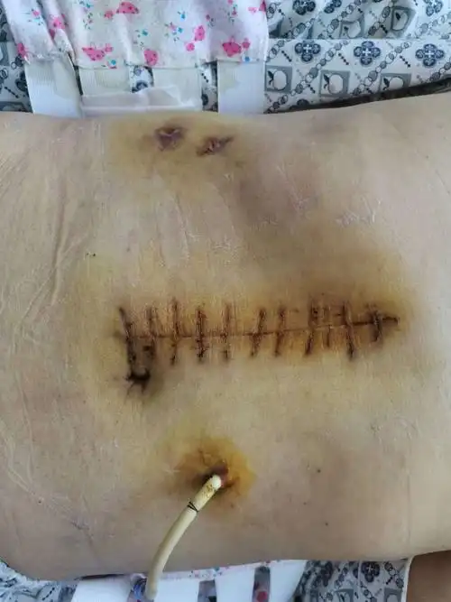 腹部切口愈合良好.